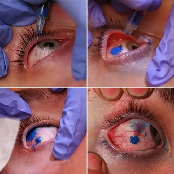 Как делают тату на глазном яблоке