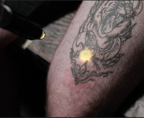 Лазерное удаление тату